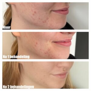 voor en na SkinPen behandeling